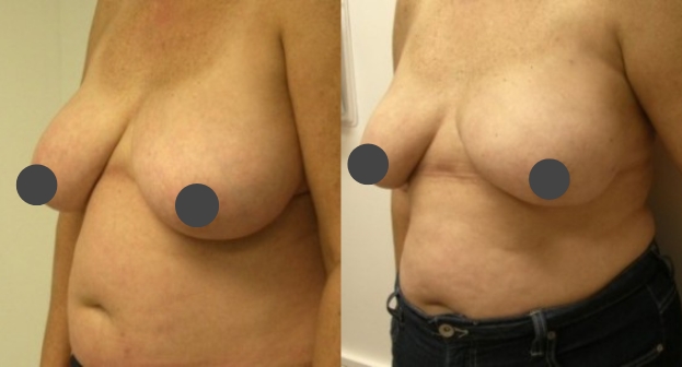 Breast reduction before and after