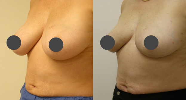 Breast reduction guilford