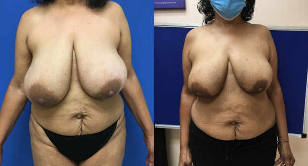 Breast Reduction Guilford