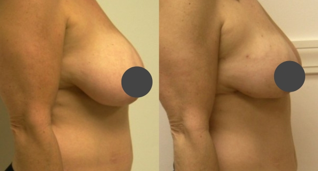 Breast reduction before and after