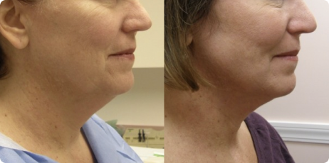 How Long Does a Laser Facelift Take?