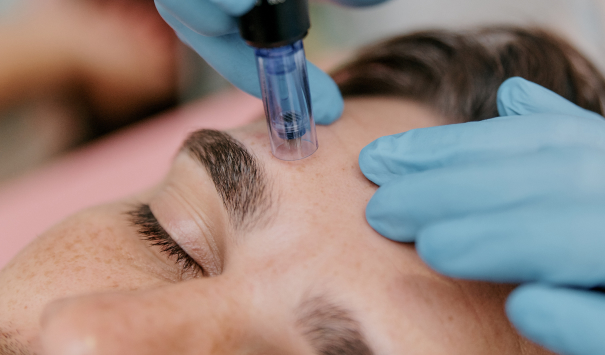RF Microneedling Non-Surgical Treatment Guilford - The Shoreline Center for Laser & Cosmetic Surgery Rf microneedling non-surgical treatment guilford