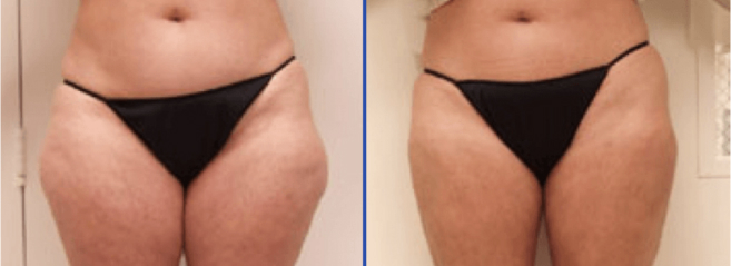 SlimLipo™ Guilford | Laser Liposuction Madison | Shoreline