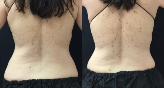 Coolsculpting guilford