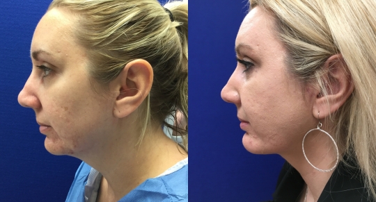 Facelift guilford