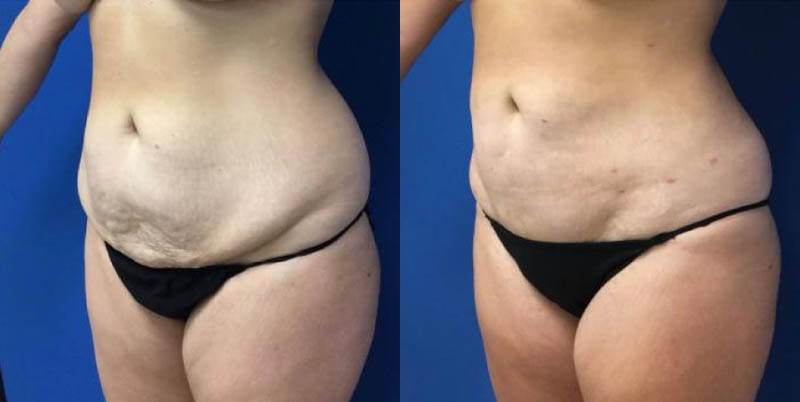 Liposuction Guilford