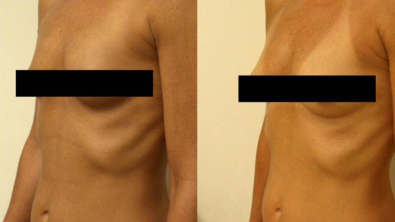 Breast augmentation guilford