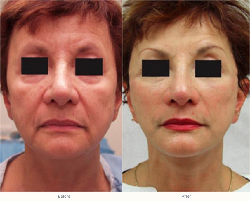 Facelift-in-New-Haven-County-Guilford-CT - The Shoreline Center for Laser & Cosmetic Surgery Facelift at guilford & madison connecticut