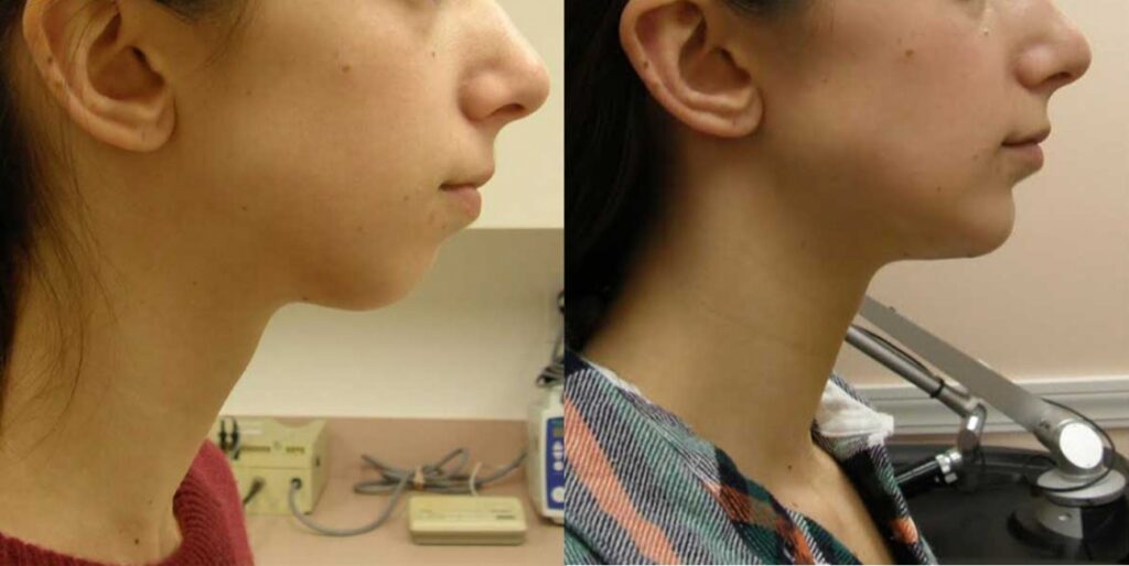 Chin Implants at Guilford & Madison Connecticut