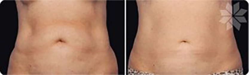 coolsculpting-guilford-langdon-center-300x91-1 - The Shoreline Center for Laser & Cosmetic Surgery Coolsculpting at guilford & madison connecticut