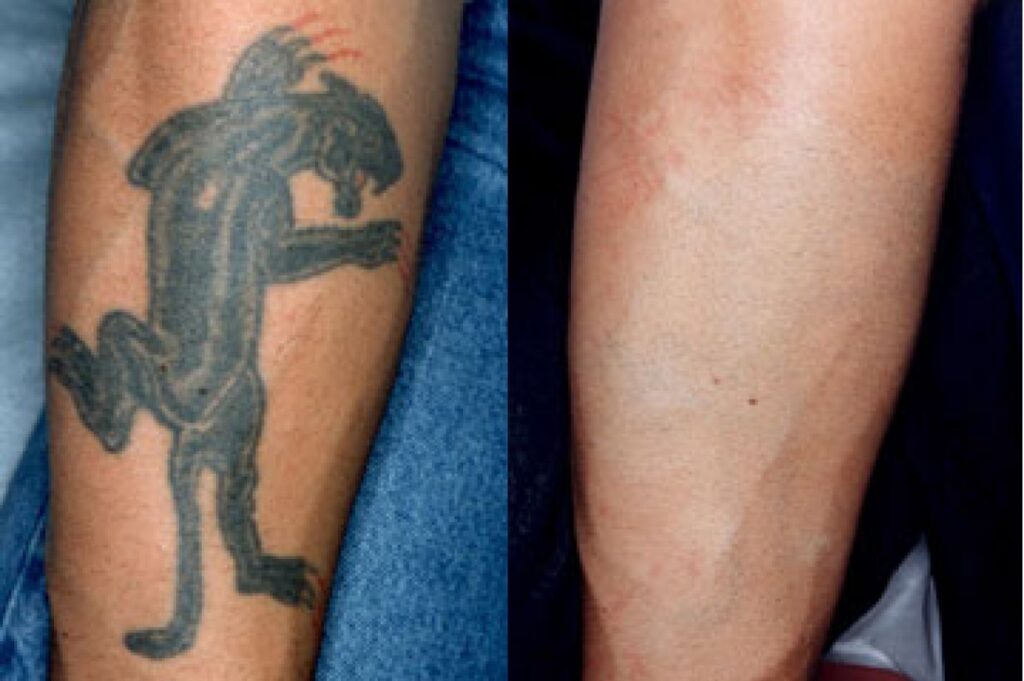 tattoo removal at Guilford & Madison Connecticut
