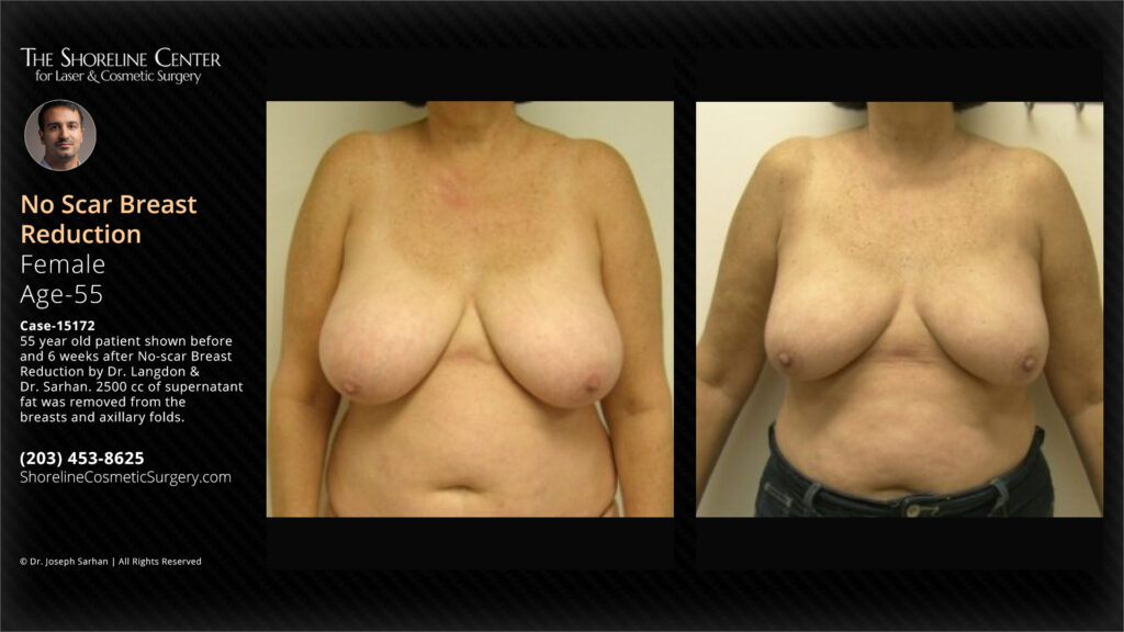 Shoreline-55-year-old-patient-No-scar-Breast-Reduction-15172-front-view - The Shoreline Center for Laser & Cosmetic Surgery Breast reduction by liposuction