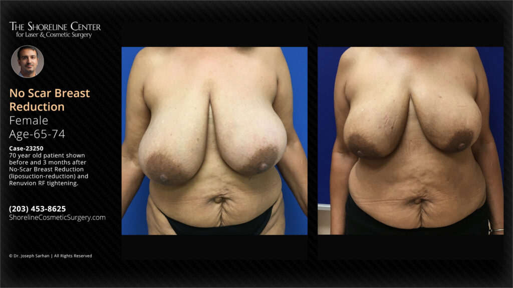 Shoreline-70-year-old-patient-No-Scar-Breast-Reduction-case-15250-front-view - The Shoreline Center for Laser & Cosmetic Surgery Breast reduction by liposuction