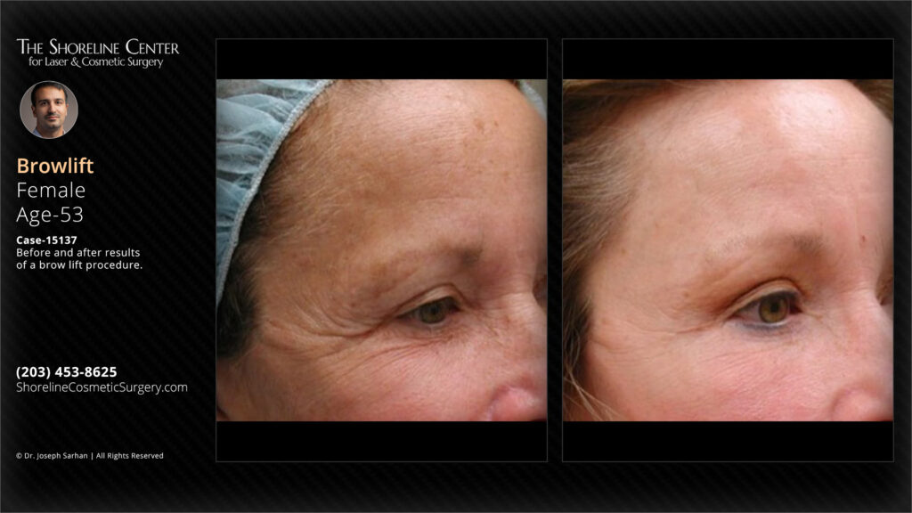 Shoreline-Female-patient-brow-lift-procedure-case-15137-diagonal-view - The Shoreline Center for Laser & Cosmetic Surgery