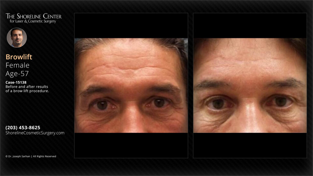 Shoreline-Female-patient-brow-lift-procedure-case-15138-Front-view - The Shoreline Center for Laser & Cosmetic Surgery