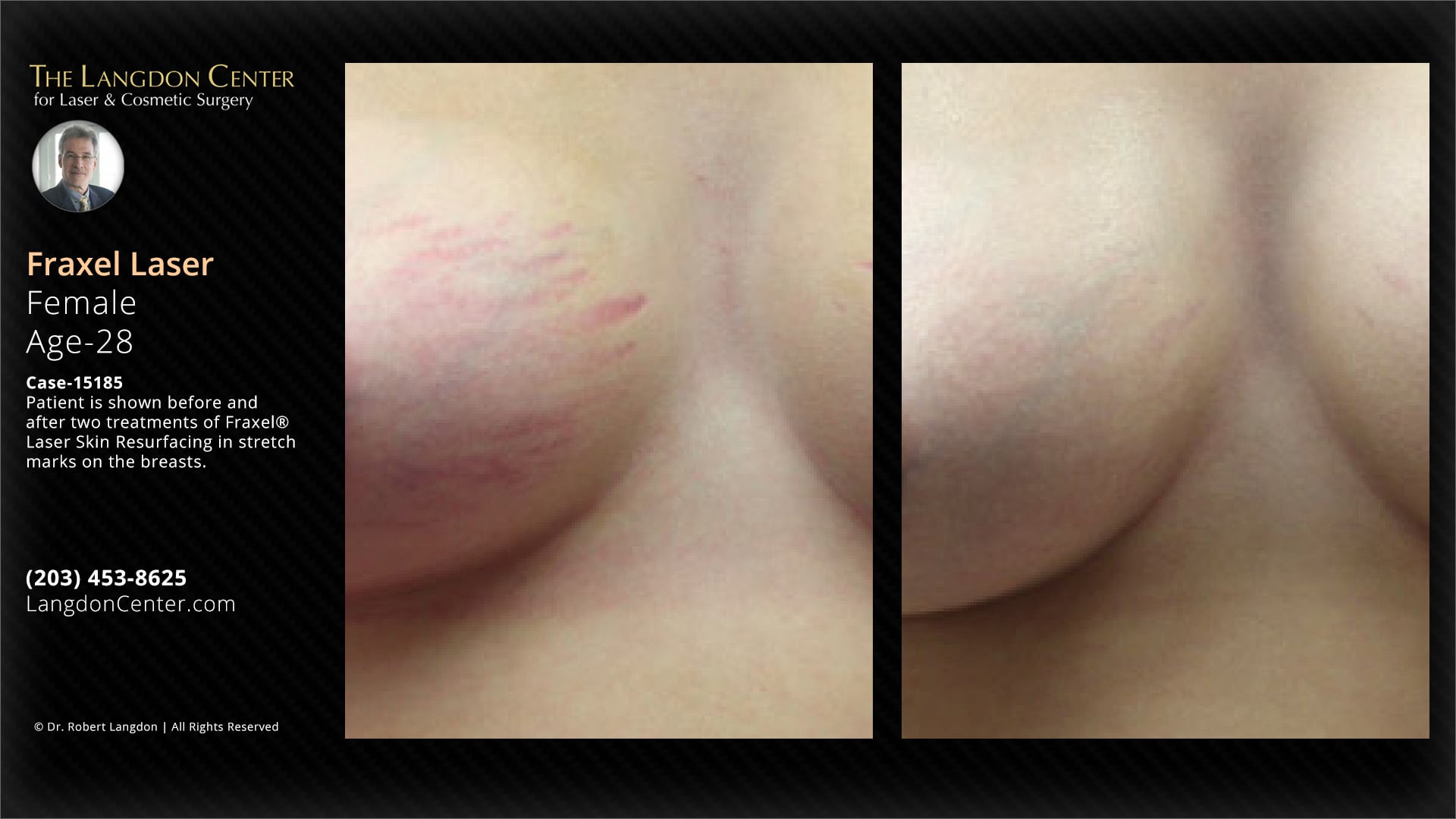 Case 15185