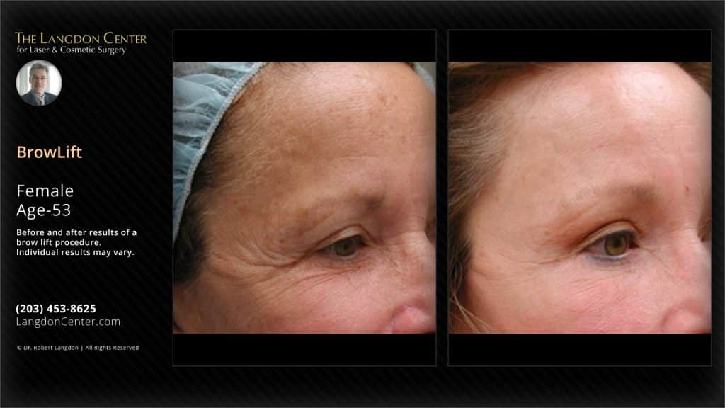 Before and after images of a 53-year-old female patient showing the results of a brow lift procedure performed at the langdon center.