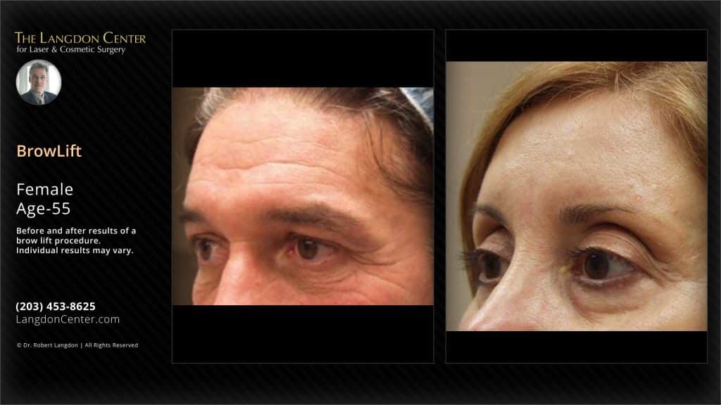 Before & after photos of a 55 year woman patient illustrating the outcomes of a brow lift surgery carried out at the langdon center, guilford, connecticut.