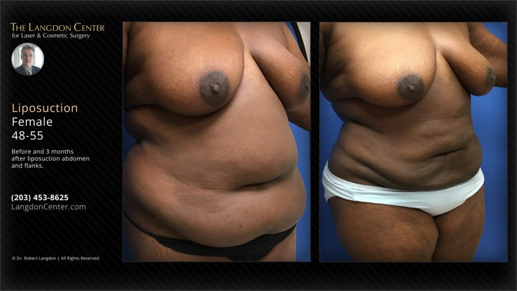 The-Langdon-Center-For-Laser-Cosmetic-Surgery-Body-Liposuction-Of-Abdomen-And-Flanks-Before-Aft-2 - The Shoreline Center for Laser & Cosmetic Surgery